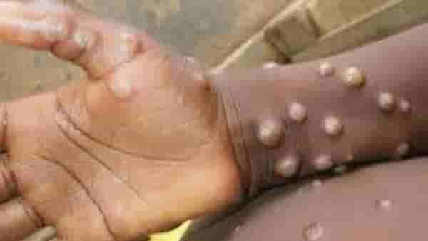 Monkey pox alert – मंकीपॉक्स आजाराबाबत केंद्र सरकार गंभीर, लवकरच मार्गदर्शक सूचना जारी करणार, नवे निर्बंध ? जगात वाढती रुग्णसंख्या