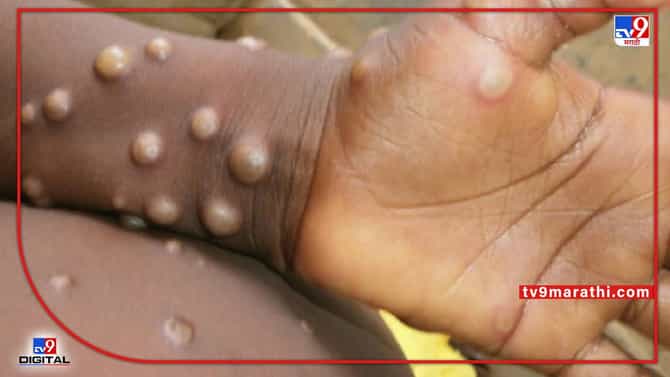 Monkeypox Virus: कोरोनानंतर जगावर मंकीपॉक्सचं संकट; मंकीपॉक्स पोहोचला 20 देशांमध्ये; WHO ने जारी केले निवेदन