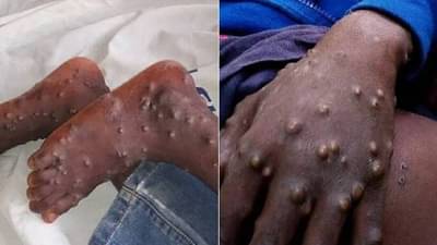 Monkeypox | 20 पेक्षा जास्त देशांमध्ये मंकीपॉक्सच्या 200 केसेस , WHO ने सांगितले व्हायरस कसा पसरतो!