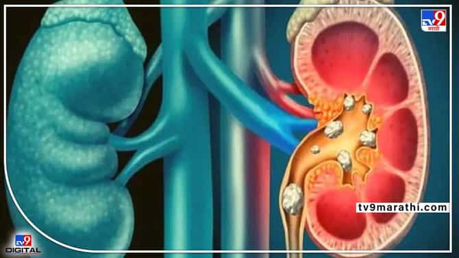 फक्त दारूच नाही तर ‘या’ गोष्टींनीही तुमचं लिव्हर होऊ शकते खराब! वेळीच व्हा सावध; लिव्हर निरोगी ठेवायचे असल्यास, या गोष्टी चुकूनही खाऊ नका
