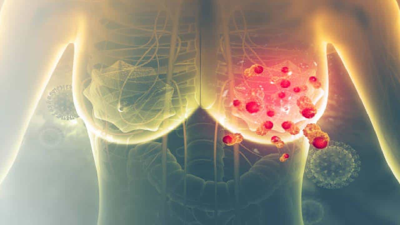Breast cancer | ब्रेस्ट कॅन्सरवरही मिळालं प्रभावी औषध! महत्त्वपूर्ण संशोधनाचा असंख्य रुग्णांना फायदा