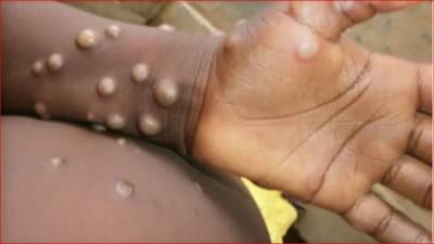 सावधान! सेक्समधून पसरतोय मंकीपॉक्स; तज्ज्ञांनी दिला सतर्कतेचा इशारा, जाणून घ्या प्रादुर्भाव रोखण्यासाठी काय काळजी घ्यावी?