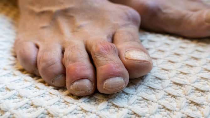 Health | शरीरात यूरिक अॅसिड वाढल्याने त्रस्त आहात? मग हे पदार्थ खाणे टाळा आणि बदल बघा!