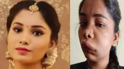 Swathi Sathish: रुट कॅनाल सर्जरीनंतर बिघडला अभिनेत्रीचा चेहरा; ओळखणंही झालं कठीण