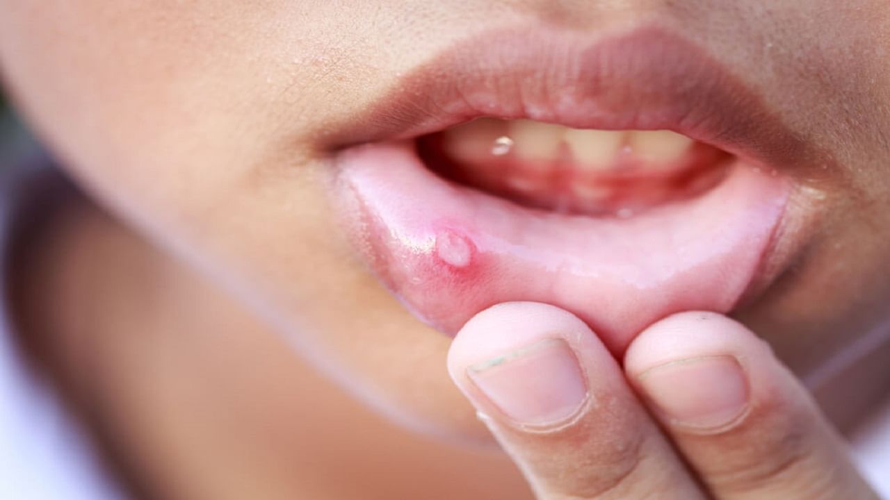 Mouth Ulcers: तोंडात वारंवार फोड येण्याने त्रास होत असेल; तर, करून पहा ‘हे’ घरगुती उपाय!