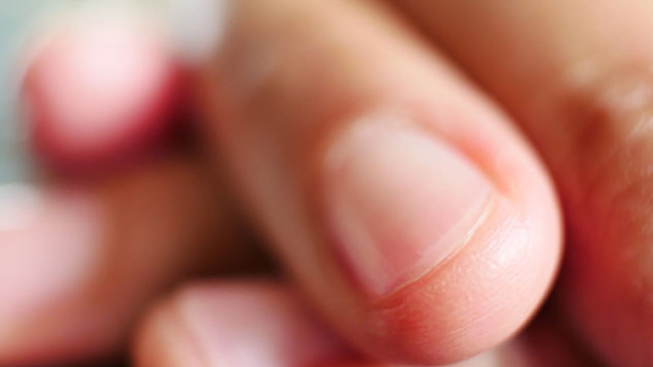 Nails: तुमची ‘नखं’ देतात गंभीर आजारांचे संकेत; ही लक्षणे दिसताच वेळीच व्हा सावध!