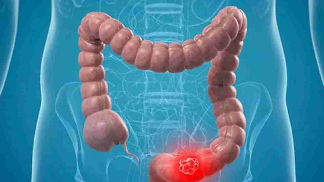 Bowel Cancer: पोटदुखीच्या अगदी छोटाशा त्रासाकडेही दुर्लक्ष नको! Bowel Cancerच्या दुर्मिळ लक्षणांबाबत जाणून घ्या