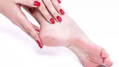 Home Remedies For Cracked Heels : पायांच्या भेगांमुळे झालात हैराण ? सोप्या, घरगुती उपायांनी आराम मिळवा...