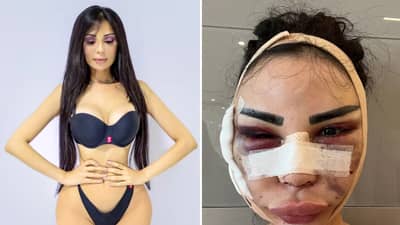 किम कार्दशियनसारखं दिसण्यासाठी केले 40 कॉस्मेटिक ऑपरेशन्स; आता मूळ रुपात परत येण्यासाठी केली कोट्यवधींची सर्जरी, चेहऱ्याची झाली अशी अवस्था