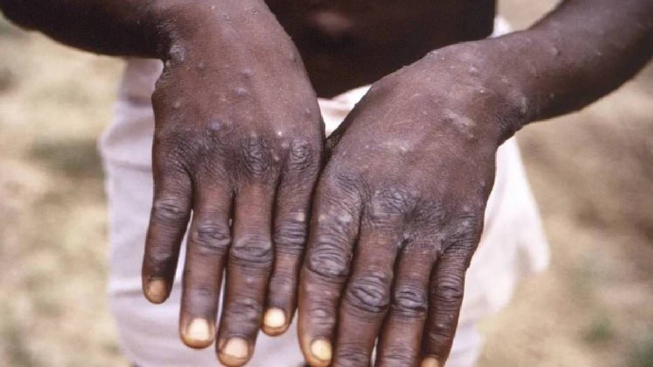 Monkeypox : मंकीपॉक्समुळे 3 संक्रमितांचा मृत्यू! WHO ने सर्व देशांना दिला सतर्क राहण्याचा इशारा
