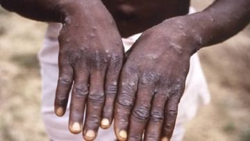 Monkeypox: टेन्शन वाढवणारी बातमी; केरळमध्ये मंकीपॉक्सचा दुसरा रुग्ण सापडल्याने खळबळ
