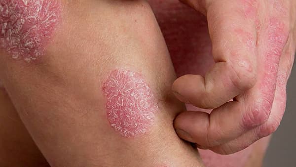 Health care | सोरायसिस आणि मानसिक आरोग्य, तज्ञांचा प्रभावी व्यवस्थापनासंदर्भात अत्यंत महत्वाचा सल्ला