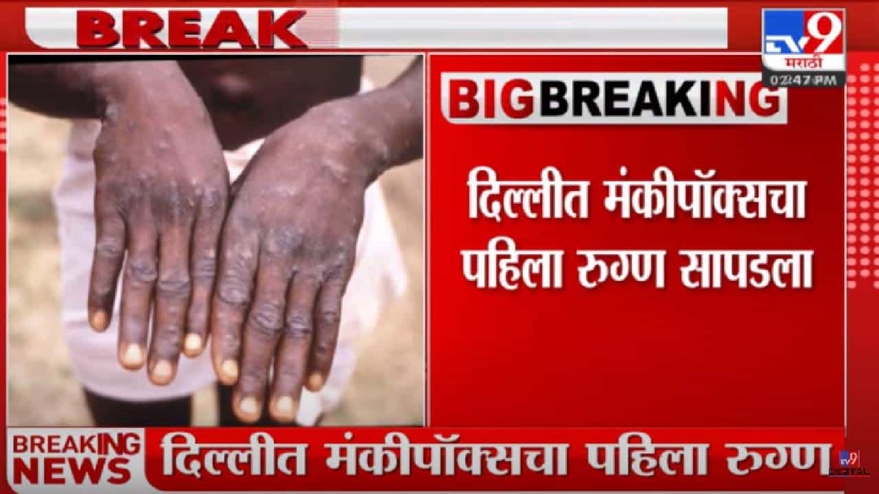 दिल्लीत मंकीपॉक्सचा पहिला रुग्ण आढळला दिल्लीत मंकीपॉक्सचा पहिला रुग्ण आढळला
