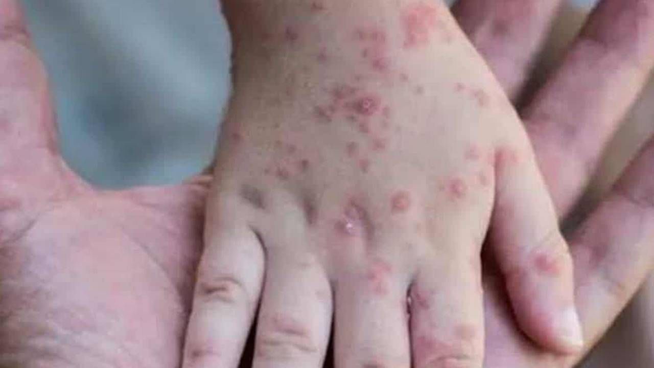 Monkeypox Virus | ‘गर्भवती महिलां’ सह मुलांना मंकीपॉक्सचा सर्वाधिक धोका; असे करा त्यांचे संरक्षण!