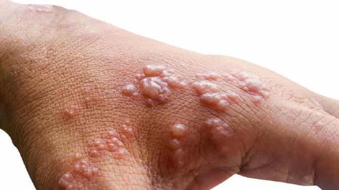 Monkeypox : लैंगिक गैरवर्तन,गळाभेट अन् चुंबनावरही आता बंधने! कोरोना प्रमाणे मंकीपॉक्स वरील मार्गदर्शक तत्त्वे लागू
