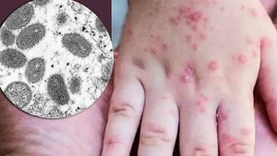 मंकीपॉक्सचा धोका वाढला: केंद्र सरकार सतर्क, लस बनवणाऱ्या कंपन्यांसाठी निविदा