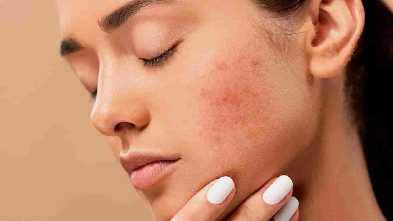 Skin Care in Monsoon: या तीन चुकांमुळे पावसाळ्यात होतो पिंपल्सचा त्रास; त्वचेची घ्या अशी काळजी