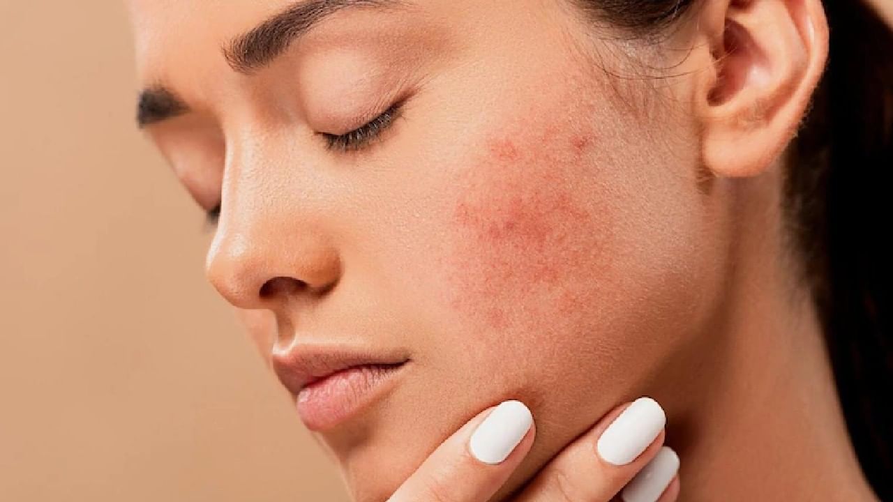 Home remedies for pimples : ‘या’ गोष्टीचा करा वापर.. चेहऱयावरील पिंपल्सची समस्या सहज होईल दूर!