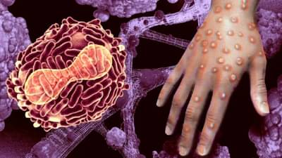 Shocking case : बाप रे....‘या’ व्यक्तीला एकाच वेळी मंकीपॉक्स, कोविड-19 आणि HIV ची लागण!
