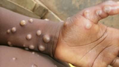 Monkeypox : मंकीपॉक्समुळे ‘मेंदूज्वरा’सह मेंदूवर येऊ शकते सूज; मंकीपॉक्सबाबत नवीन अभ्यास आला समोर!