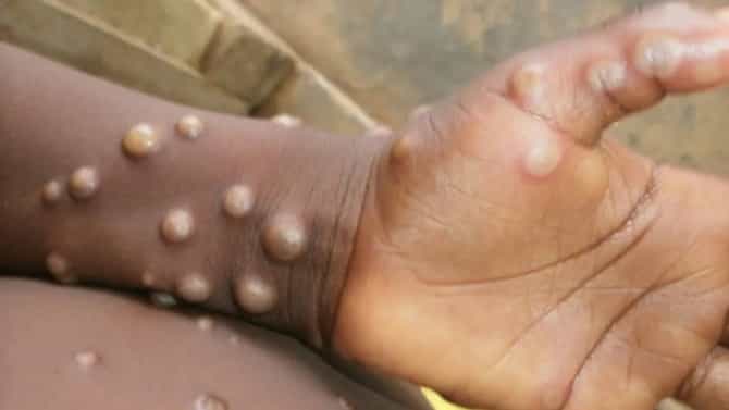 MonkeyPox : मंकीपॉक्सबाबत केंद्र सरकार अॅक्शन मोडमध्ये; लक्ष ठेवण्यासाठी टास्क फोर्सची स्थापना