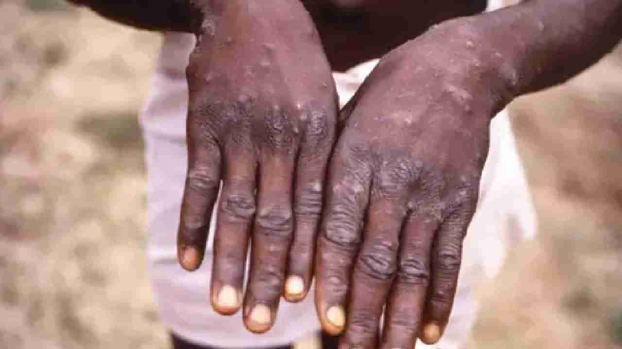 Monkeypox : भारताता मंकीपॉक्सचा शिरकाव, केरळमध्ये आढळला पहिला रुग्ण, एनआयव्हीकडून अधिकृत दुजोरा