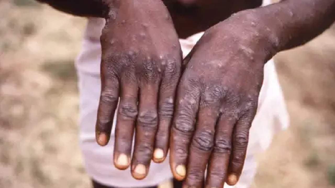 Monkeypox : भारताता मंकीपॉक्सचा शिरकाव, केरळमध्ये आढळला पहिला रुग्ण, एनआयव्हीकडून अधिकृत दुजोरा