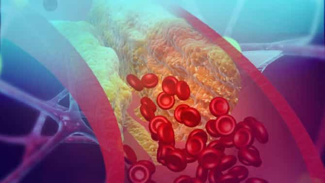 High Cholesterol : शरीरात कोलेस्टेरॉलची पातळी सातत्याने वाढते आहे? मग हे खास उपाय करा आणि निरोगी जीवन जगा!