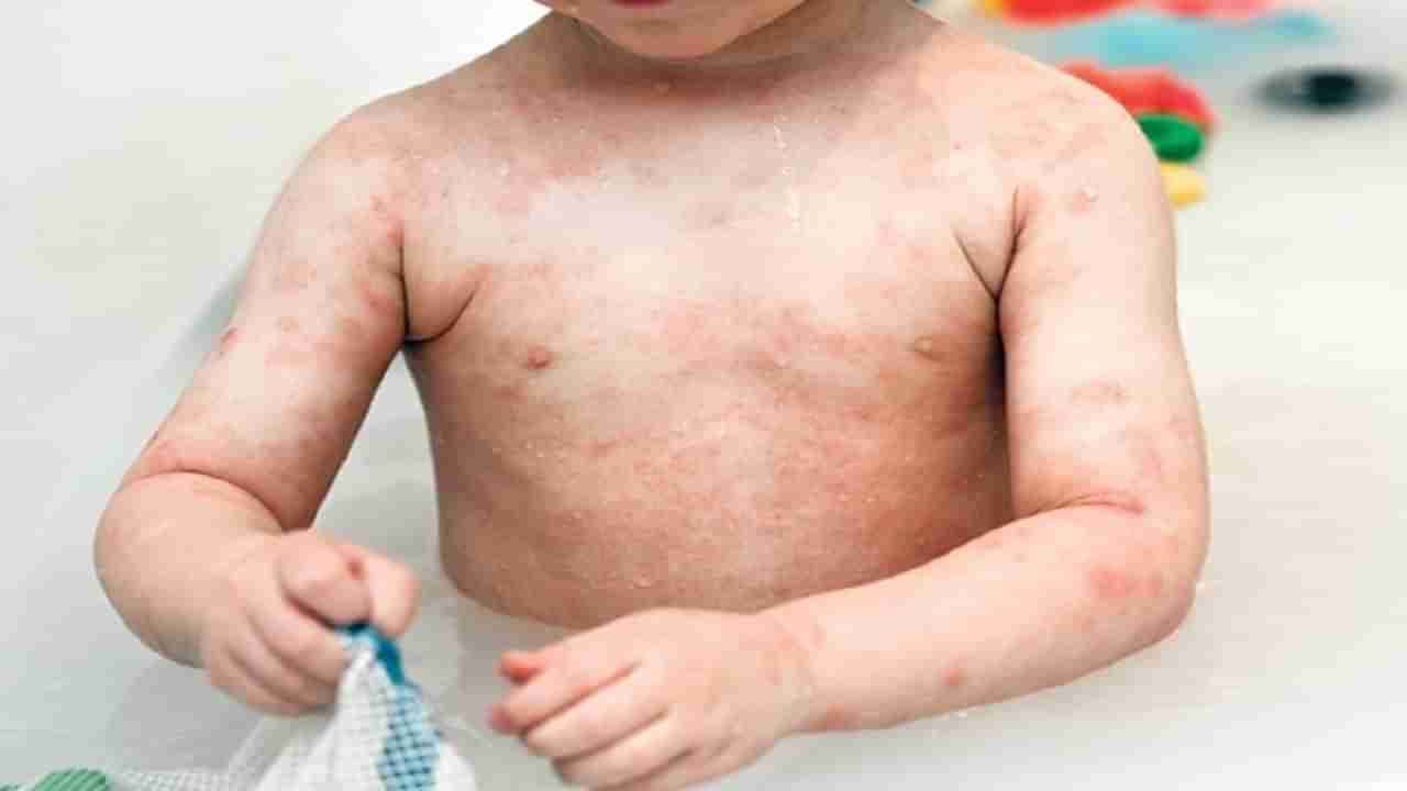 बदलत्या ऋतूमानाशिवाय या कारणांमुळेही लहान मुलांना होऊ शकतो ॲलर्जीचा त्रास, करून पहा हे उपाय