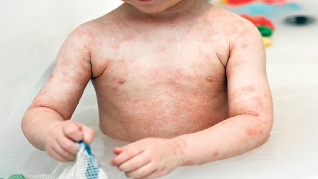 बदलत्या ऋतूमानाशिवाय या कारणांमुळेही लहान मुलांना होऊ शकतो ॲलर्जीचा त्रास, करून पहा 'हे' उपाय