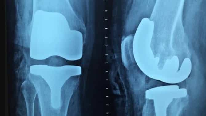 World Bone And Joint Day: वृद्धापकाळात पडणे आणि दुखापतीचा धोका कसा कमी करायचा? जाणून घ्या, सोपे उपाय