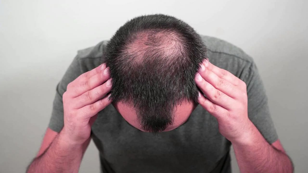 Baldness: टक्कल पडल्यास घाबरू नका; शास्त्रज्ञांनी शोधला प्रभावी उपाय!