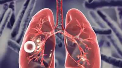 Nagpur Health : क्षयरुग्णांना पोषण आणि सामाजिक सहाय्य योजना, कम्युनिटी सपोर्ट टू टीबी पेशंट उपक्रम