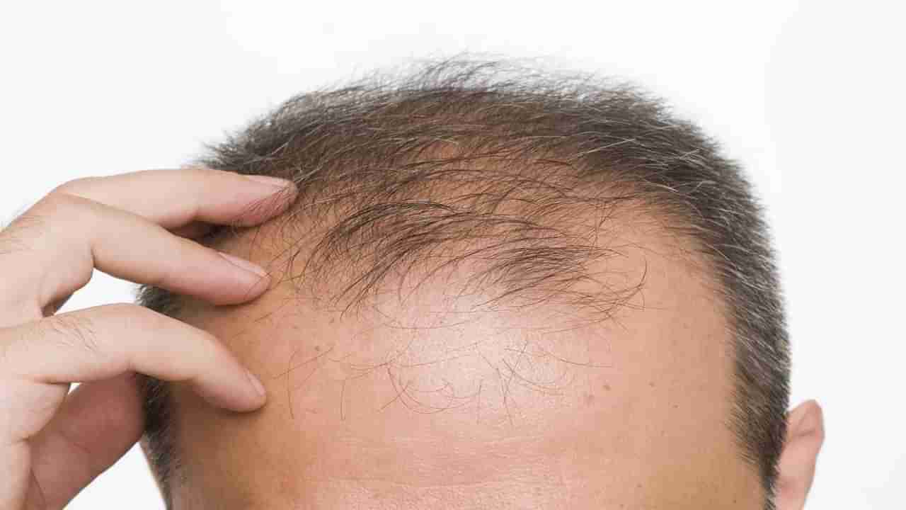 Hair loss : तुम्हीही ‘या’ गोष्टी जास्त खाता का? तर, आजच करा बंद; नाहीतर लवकर पडेल तुमचे टक्कल!