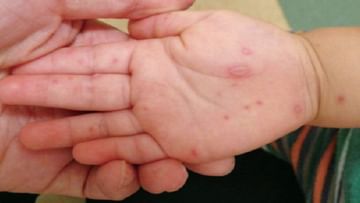 Hand Foot Mouth Disease: एचएफएमडी रोगाचा होतोय लहान मुलांना संसर्ग; जाणून घ्या, काय आहेत ‘या’ आजाराची लक्षणे!