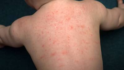 Tomato flu: आता देशात लहानग्यांना टोमॅटो फ्लूचा धोका, केरळातून देशाच्या इतर भागात आजार पसरण्याची भीती, काळजी घेण्याचे आवाहन