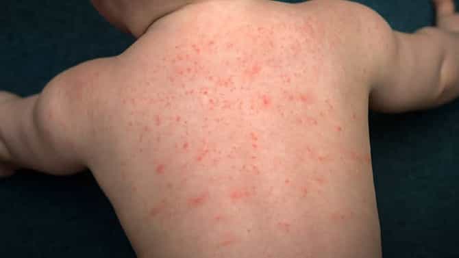 Tomato flu: आता देशात लहानग्यांना टोमॅटो फ्लूचा धोका, केरळातून देशाच्या इतर भागात आजार पसरण्याची भीती, काळजी घेण्याचे आवाहन