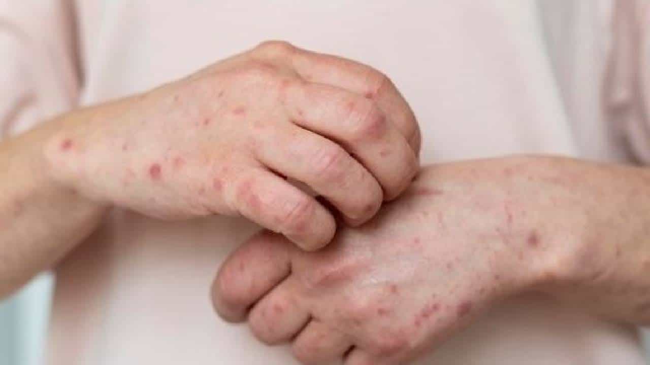 Tomato fever : भारतातही झपाट्याने पसरतोय ‘टॉमेटो फिव्हर’ जाणून घ्या, काय आहेत लक्षणे? कोणाला आहे सर्वाधिक धोका!