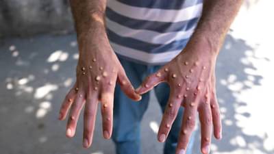 Monkey pox: मंकीपॉक्सच्या लक्षणांच्या उपचारांसाठी अँटीव्हायरल Tecovirimat प्रभावी, संशोधनातून खुलासा