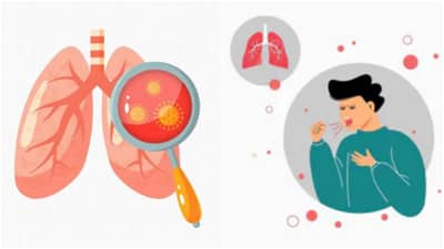 TB : घातक क्षयरोगाची वाढतेय आकडेवारी! लक्षणं काय? काळजी काय घ्याल? वाचा सविस्तर...
