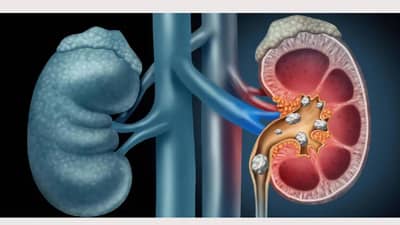 Kidney disease: ही लक्षणे असू शकतात पॉलिसिस्टिक किडनी रोगाचे संकेत, असा करा बचाव