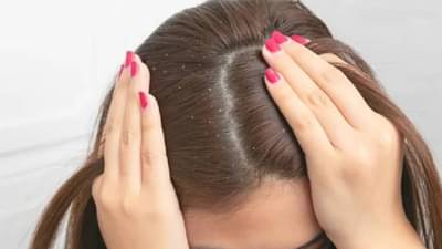 लिंबाच्या मदतीने करा कोंड्याची समस्या दूर, जाणून घ्या वापर करण्याची पद्धत