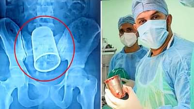 पोटातून निघाला चक्क स्टीलचा ग्लास, पण हा ग्लास पोटात गेला कसा?