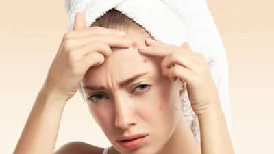 Beauty Tips: त्वचेसाठी धोकादायक ठरतात White Pimples! जाणून घ्या बचावाचे उपाय