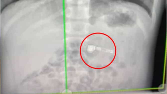 औषध समजून Apple चा airpod गिळला, X-Ray मध्ये तर स्पष्ट दिसलं! या airpod ने पोटात जाऊन पण सगळं रेकॉर्ड केलं
