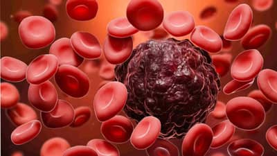 Cancer: पायांमध्ये वेदना होणे आणि सूज ही असू शकतात या कॅन्सरची लक्षणे