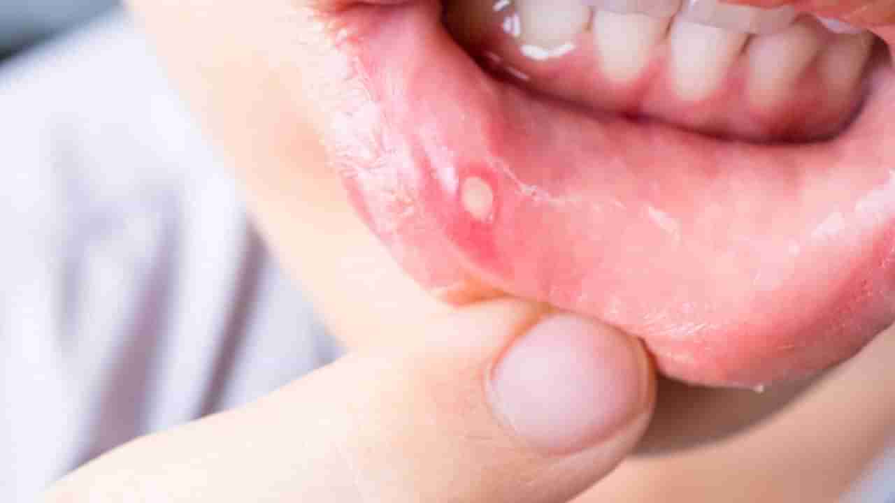 Mouth Ulcer: या 3 पोषक तत्वांच्या कमतरतेमुळे होतो तोंड येण्याचा त्रास , घरच्या घरी करा हे उपाय