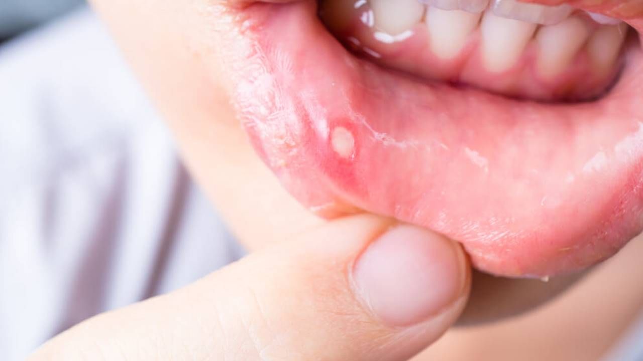 Mouth Ulcer: 'या' 3 पोषक तत्वांच्या कमतरतेमुळे होतो तोंड येण्याचा त्रास , घरच्या घरी करा हे उपाय