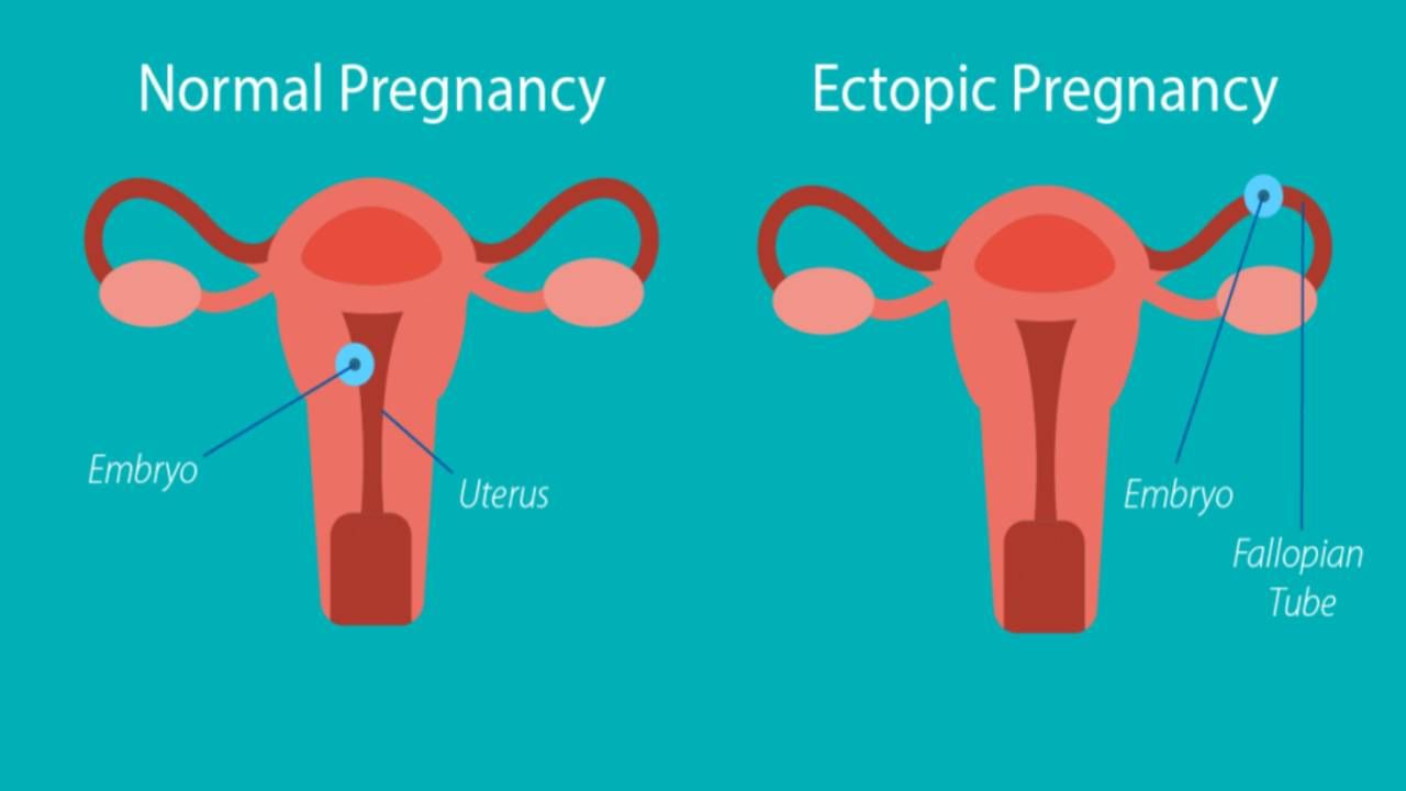 ectopic-pregnancy-marathi-news