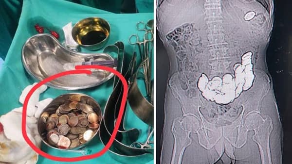 शस्त्रक्रियेदरम्यान पोटात आढळली तब्बल 187 नाणी, X-ray मध्ये दिसल्या अनेक गोष्टी